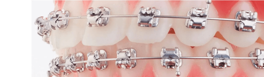 Orthodontie de l’adolescent